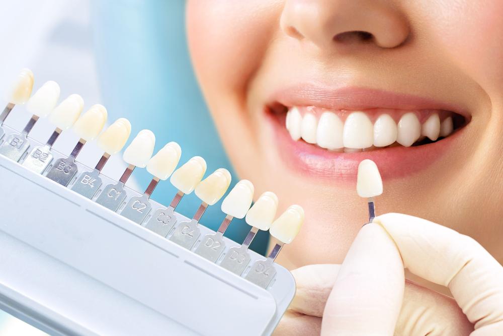 Teeth Whitening Cloverdale