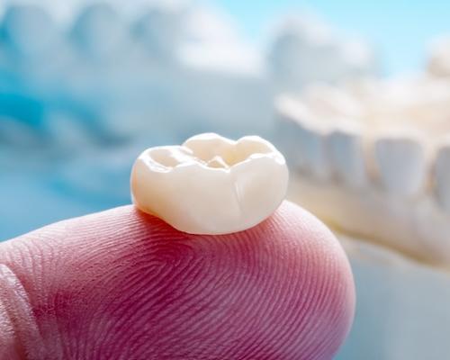 A image of a dental crown in Cloverdale, WA