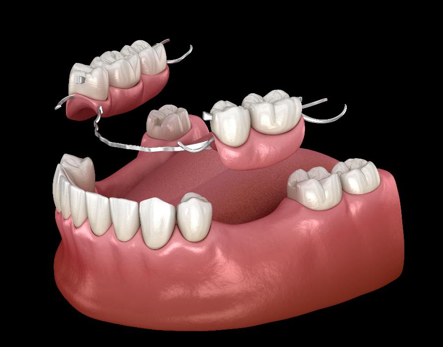 Dentures Cloverdale