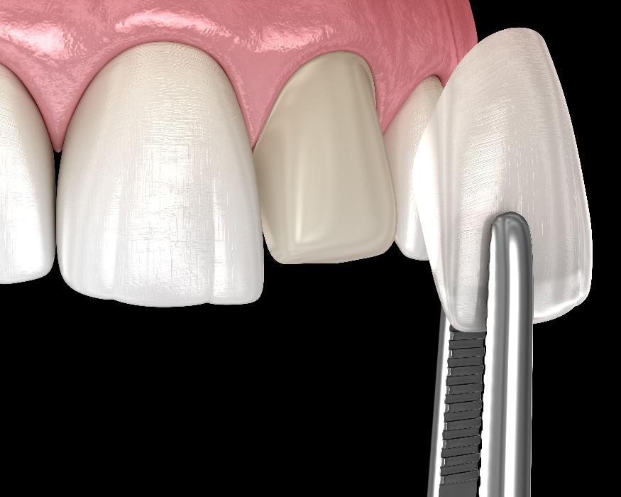 Porcelain Veneers Cloverdale
